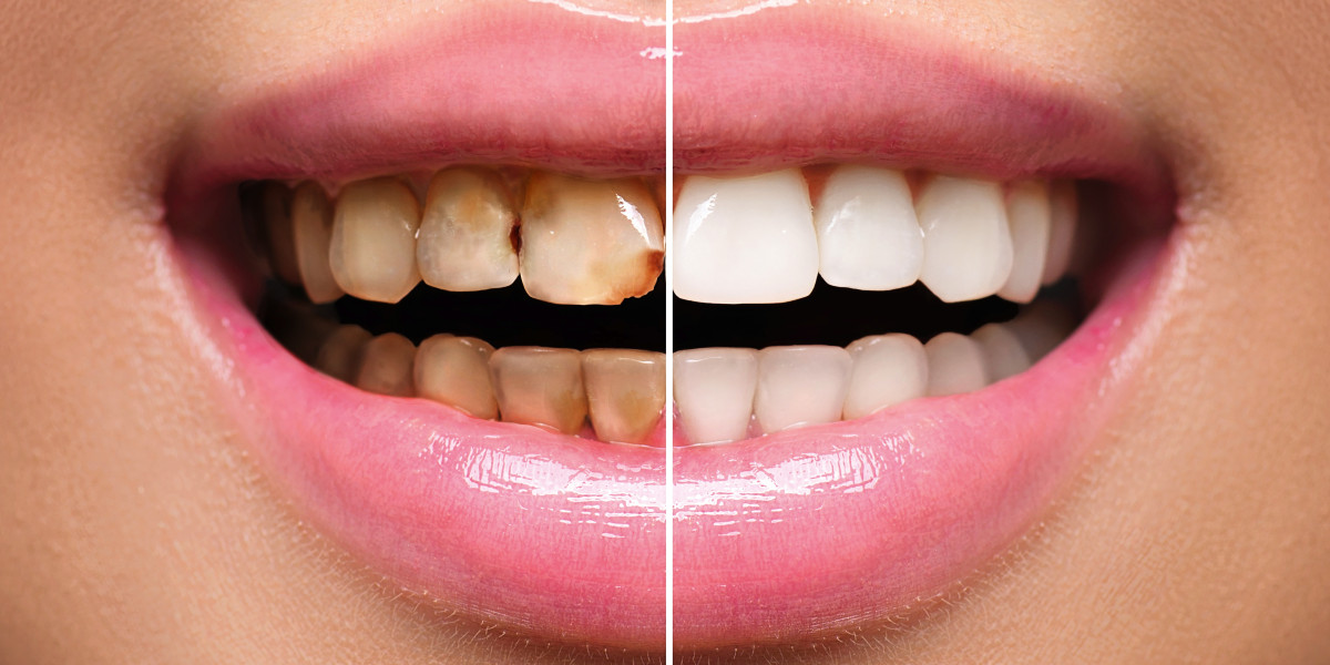 How Restorative Dentistry Helps Restore Confidence and Smile Aesthetics