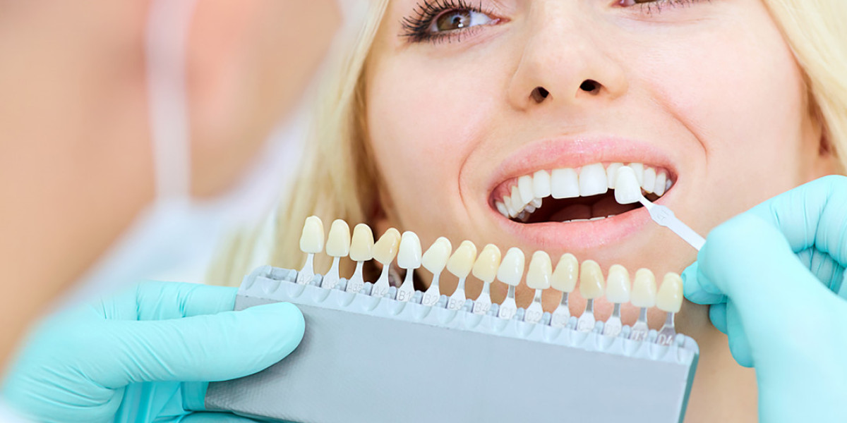 The Step-by-Step Procedure of Getting Dental Veneers