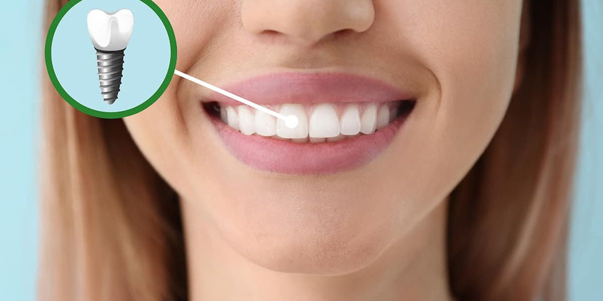 Everything You Need to Know About Dental Implants: A Complete Guide