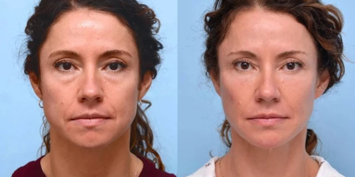 Thread lift treatment in Dubai: Youthful Contours Through Modern Techniques