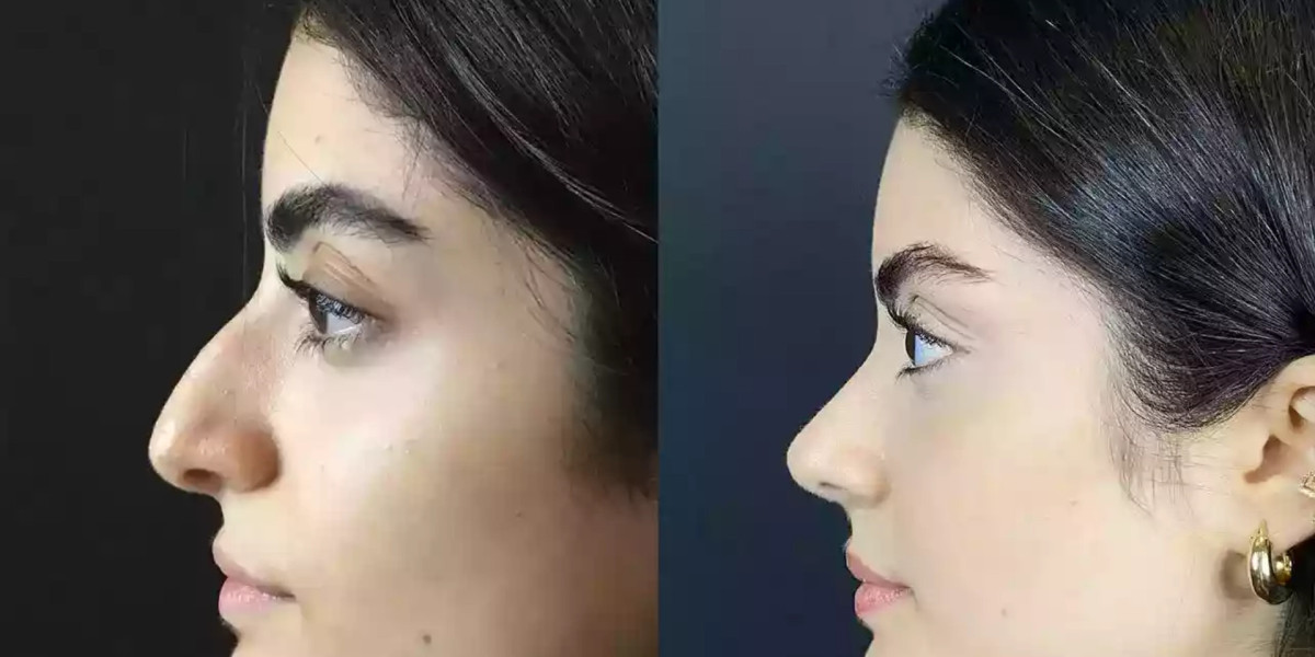 Can the Best Rhinoplasty Surgeon in Dubai Deliver Natural Results?