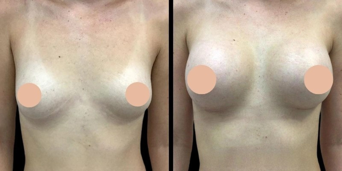 Fitness Tips After Breast Augmentation in Dubai