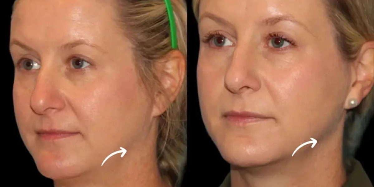 Sculptra Fillers and Beauty Psychology at the Best Aesthetic Clinic in Dubai