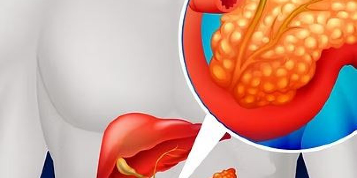 Pancreatic Cancer Singapore: Choosing the Right Treatment for Better Outcomes