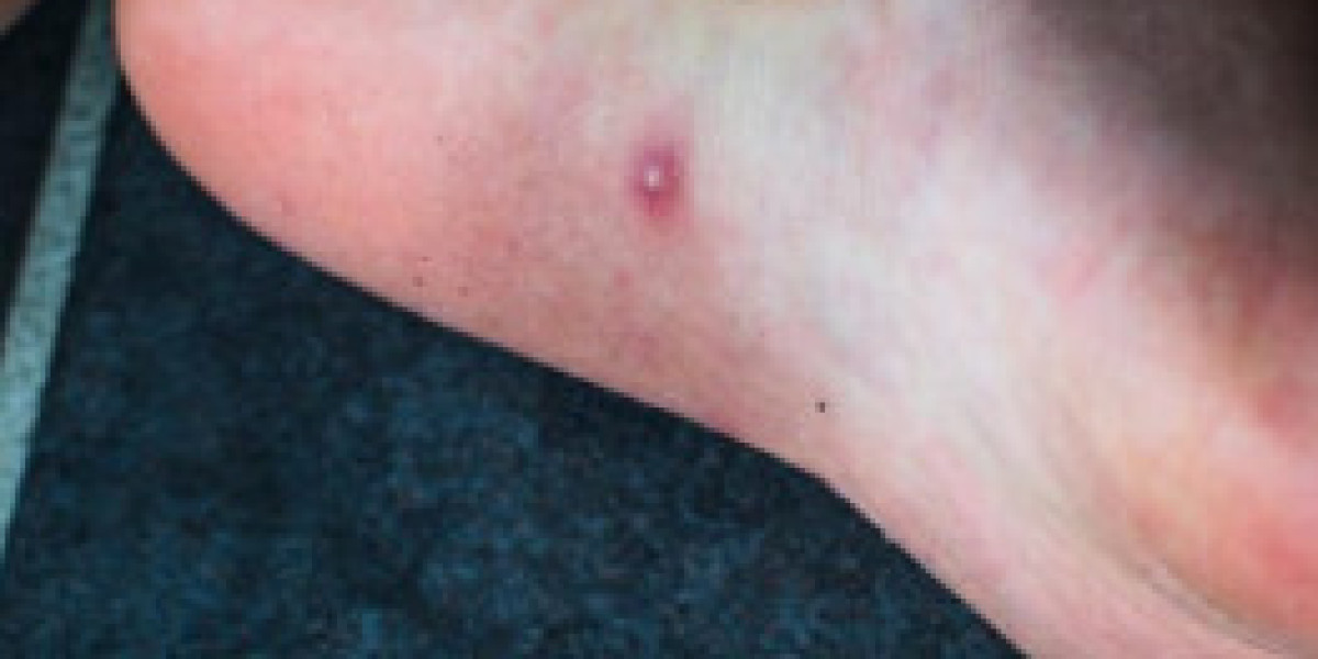 Wart vs Corn: Causes, Symptoms, and the Best Treatment Options