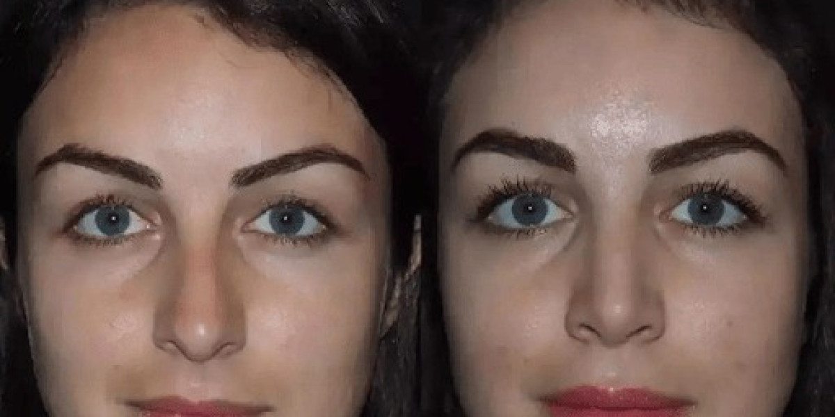 Nose Surgery in Dubai: Choosing the Best Treatment for Your Goals